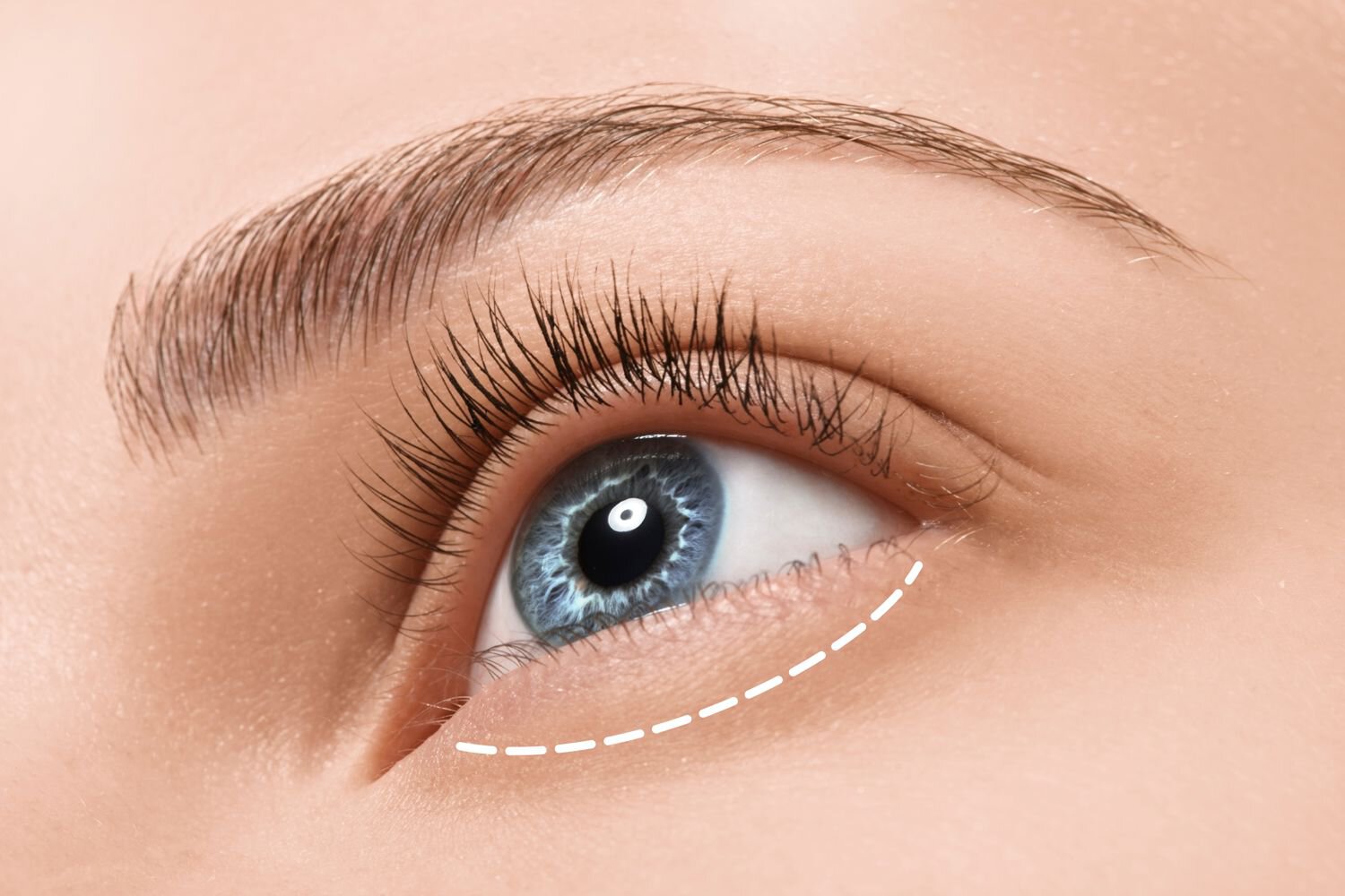 How lower eyelid surgery is performed