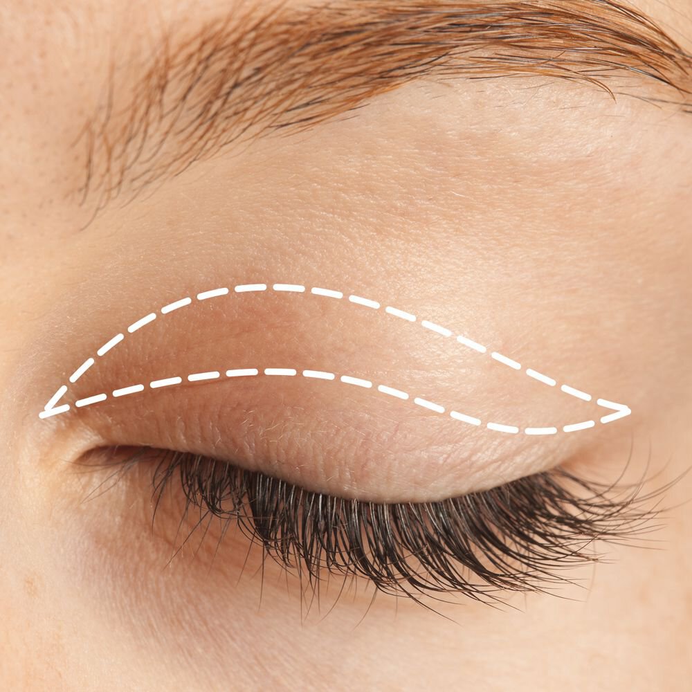 Illustration of the area treated during upper eyelid surgery