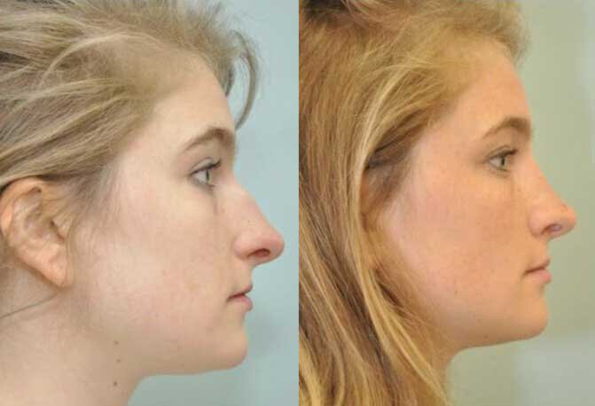 Fairfield County Rhinoplasty Before and After