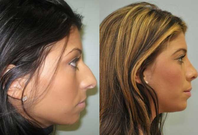Fairfield County Ethnic Rhinoplasty Before and After
