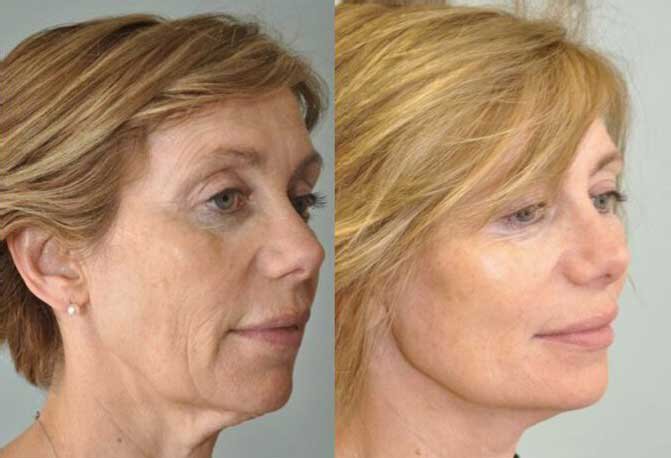Fairfield County Facelift Before and After