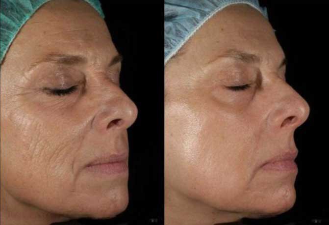 Fairfield County Skin Resurfacing Before and After