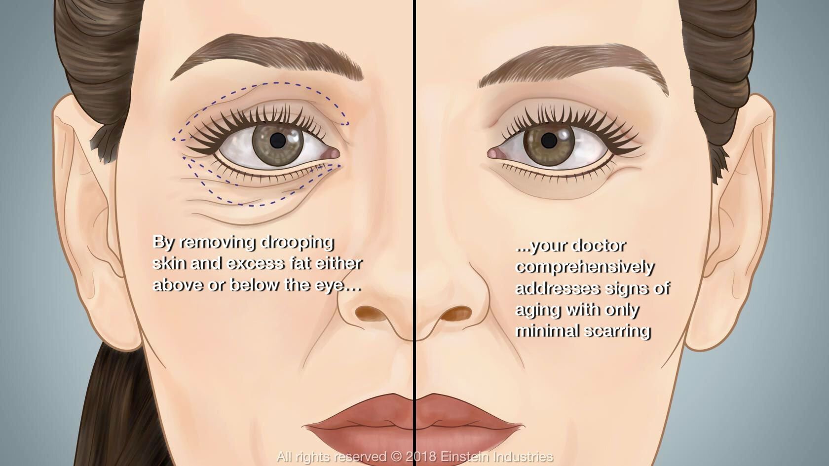 eyelid surgery infographic