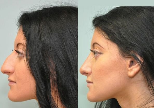 Fairfield County rhinoplasty before and after model