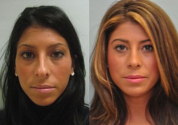 Fairfield County rhinoplasty before and after model