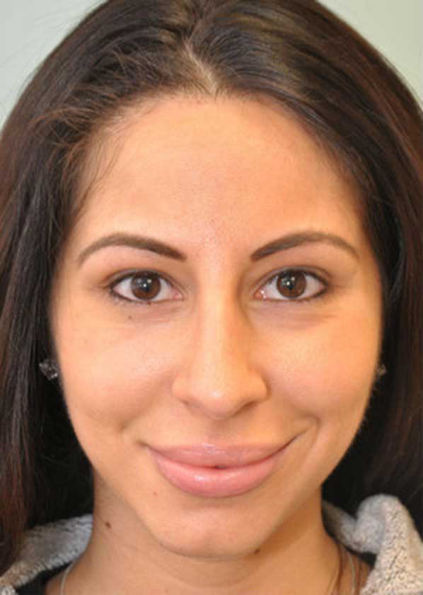 Fairfield County revision rhinoplasty before photo