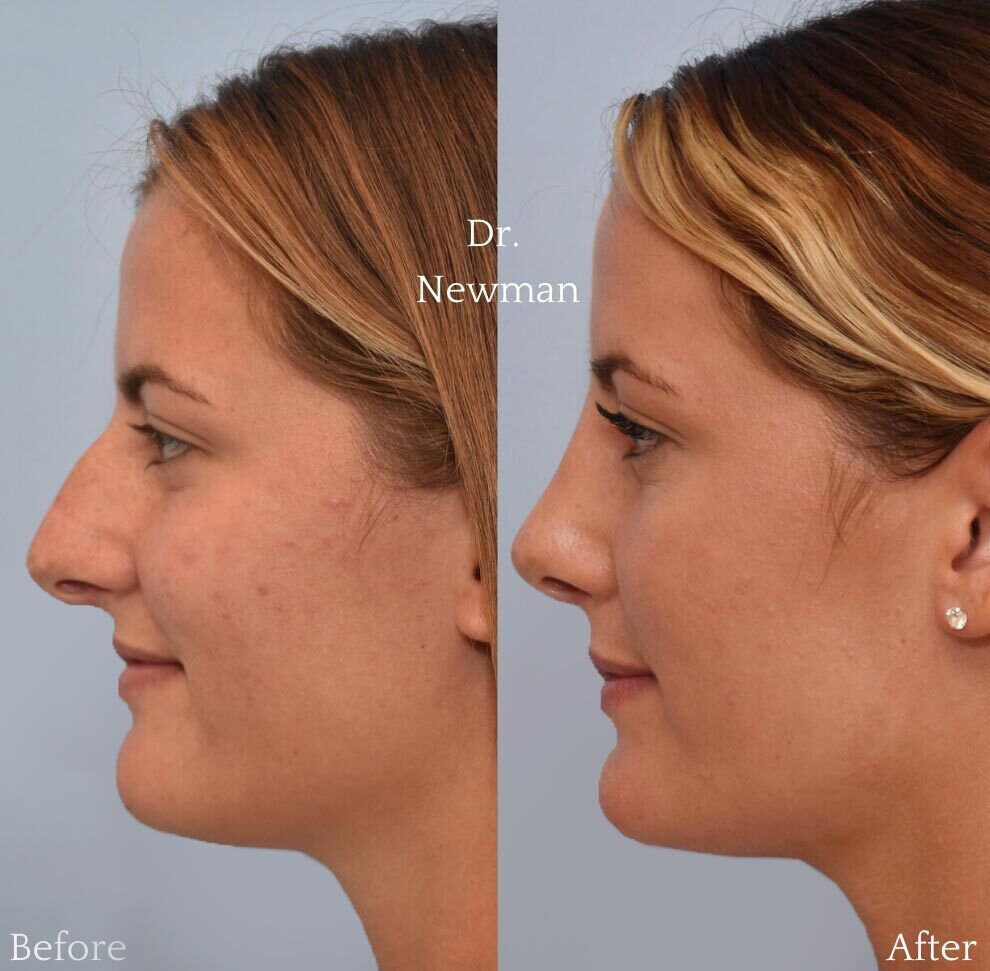 Fairfield County rhinoplasty before and after photo