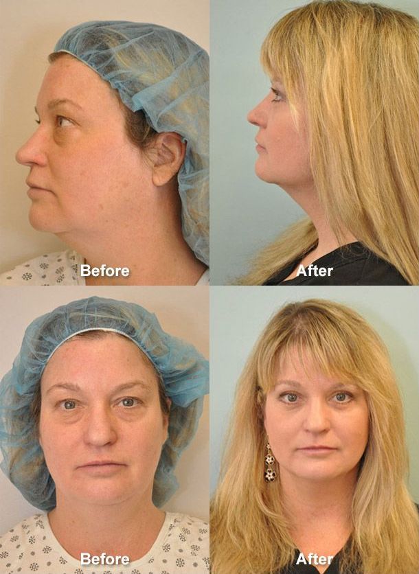 Fairfield County liposuction before and after photos